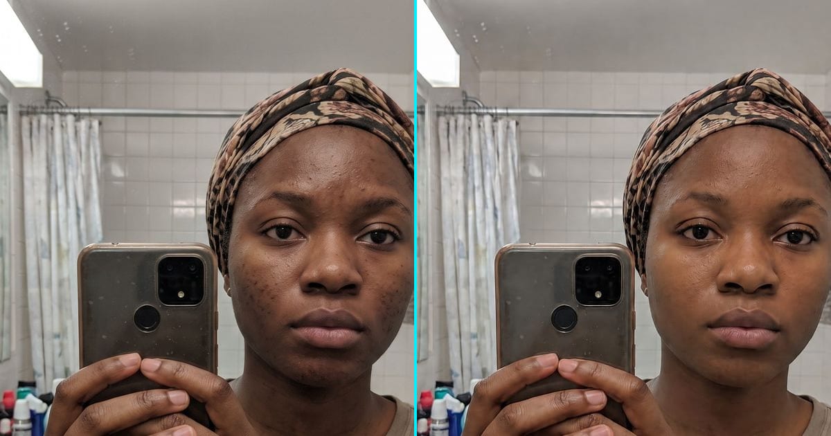 Peau Nette : avant et après